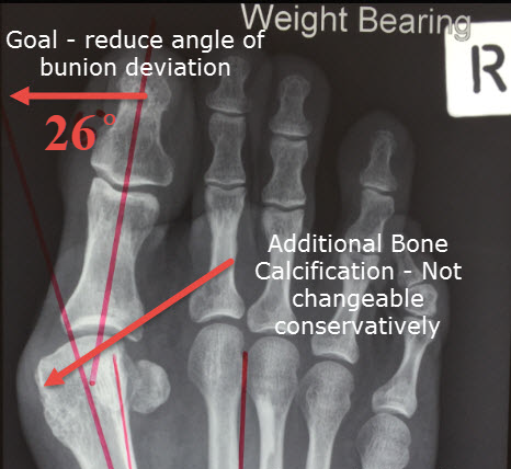 Bunion X-Ray