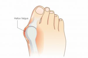 Picture of a bunion