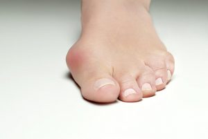 Inflamed bunions