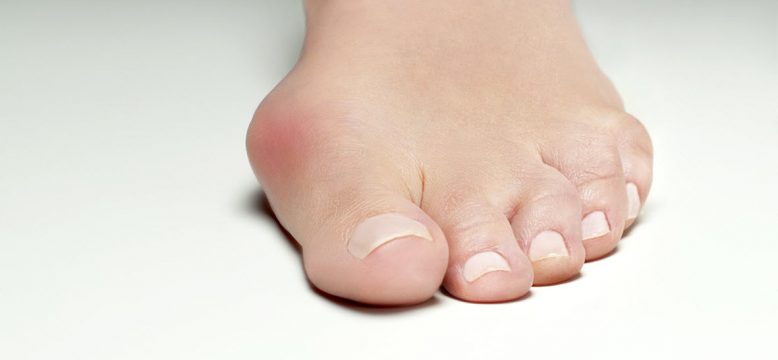 Inflamed bunions