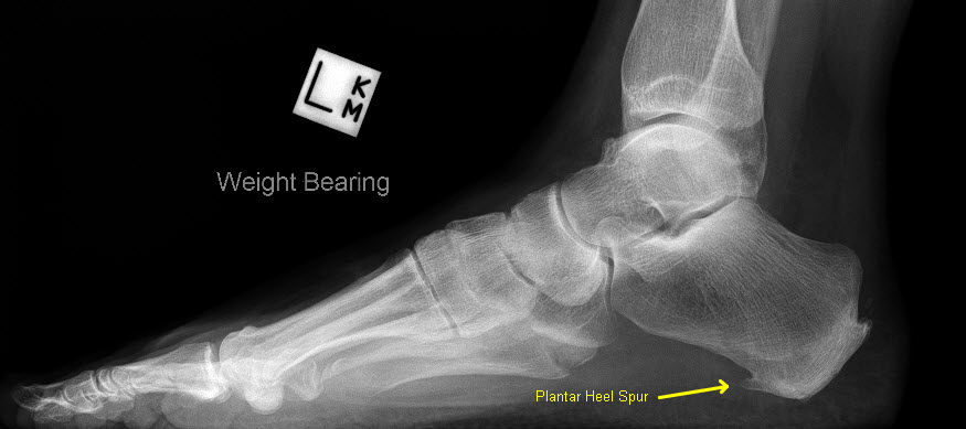 Heel Spur left foot