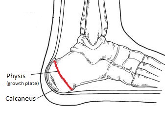 Picture of heel growth plate