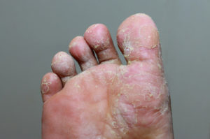 Foot infected with Athletes Foot